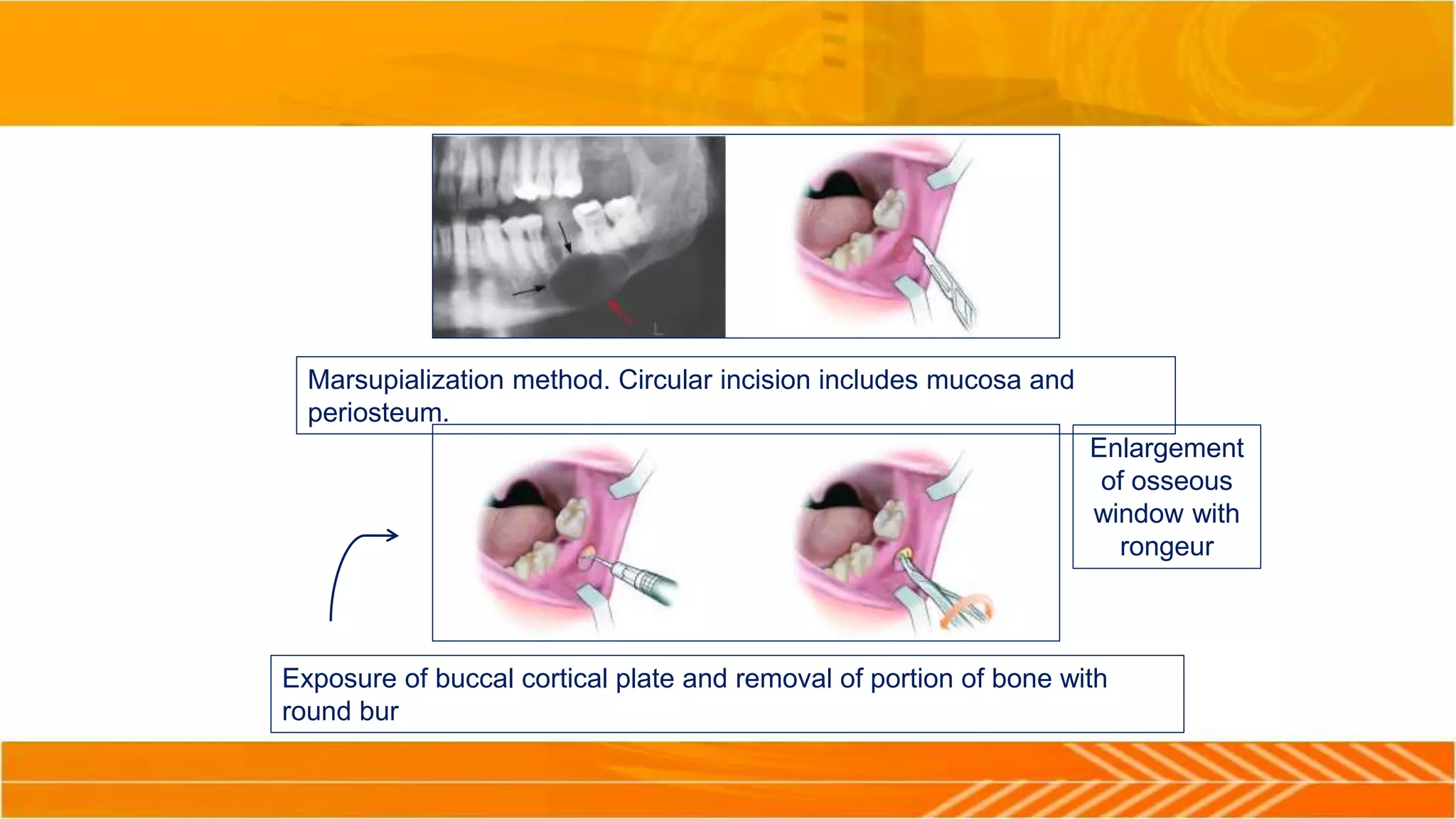 Marsupialization method. Circular incision includes mucosa and
periosteum.
Exposure of buccal cortical plate and removal of portion of bone with
round bur
Enlargement
of osseous
window with
rongeur
 