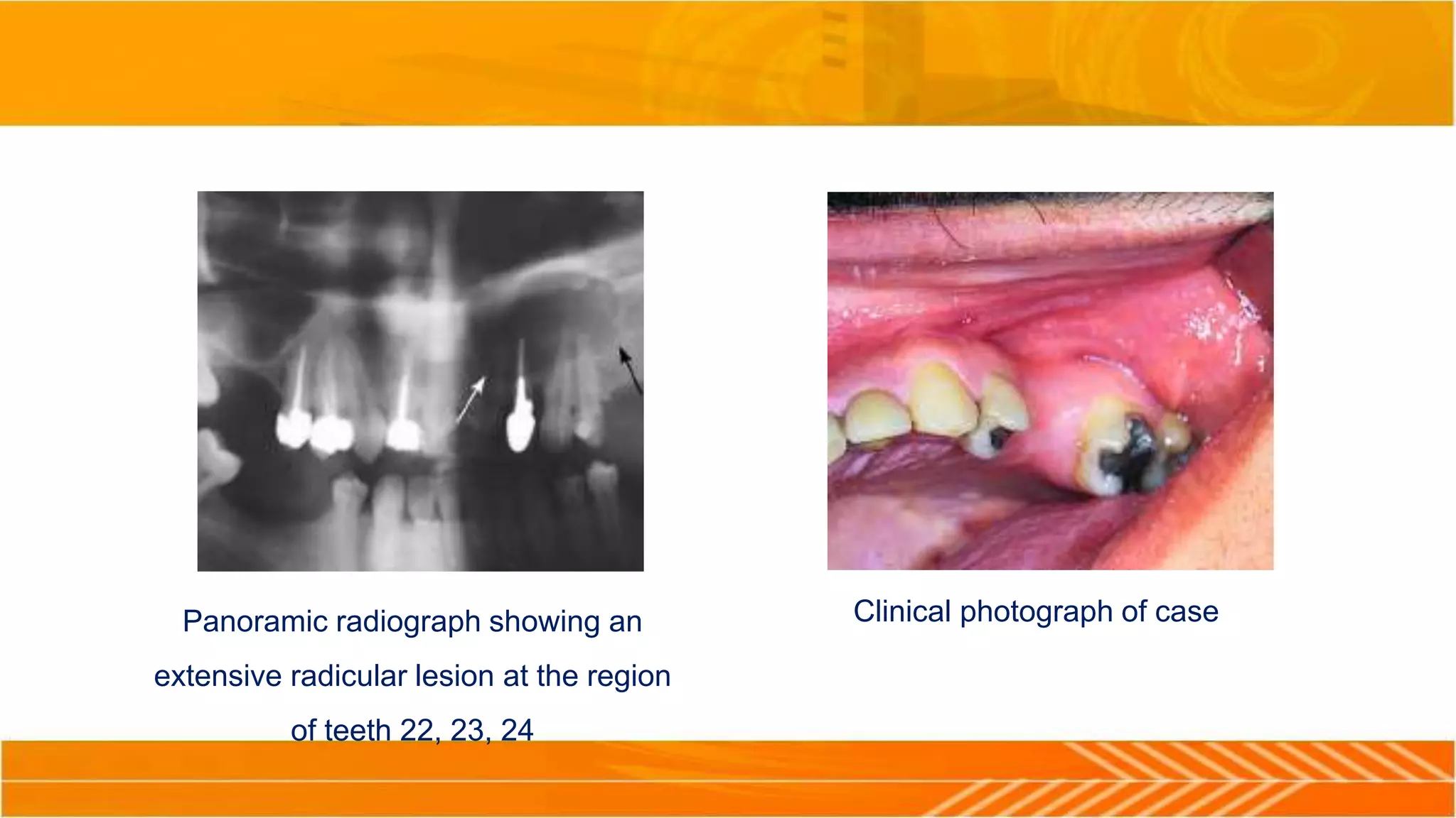 Panoramic radiograph showing an
extensive radicular lesion at the region
of teeth 22, 23, 24
Clinical photograph of case
 