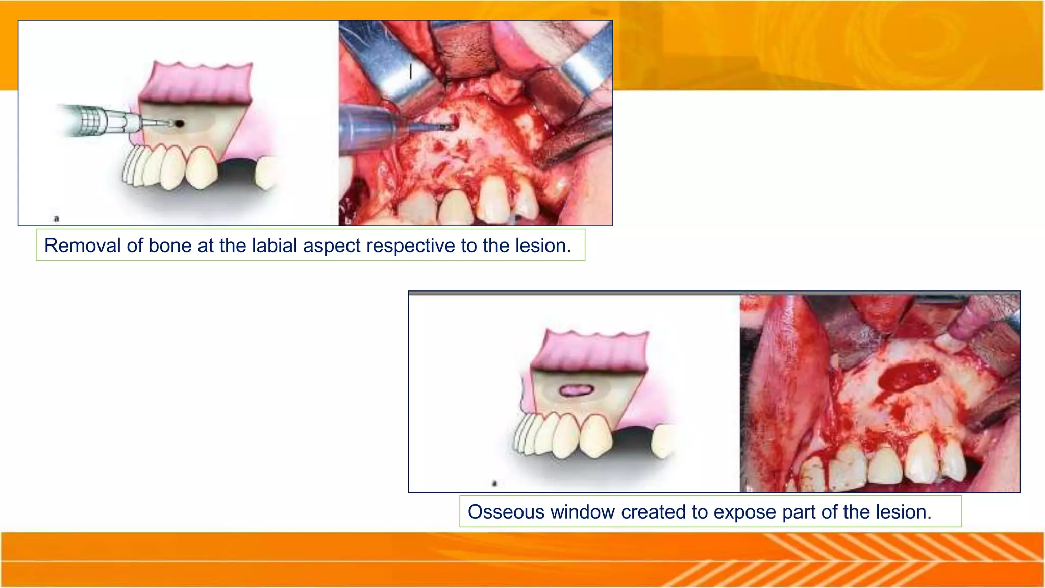 Removal of bone at the labial aspect respective to the lesion.
Osseous window created to expose part of the lesion.
 