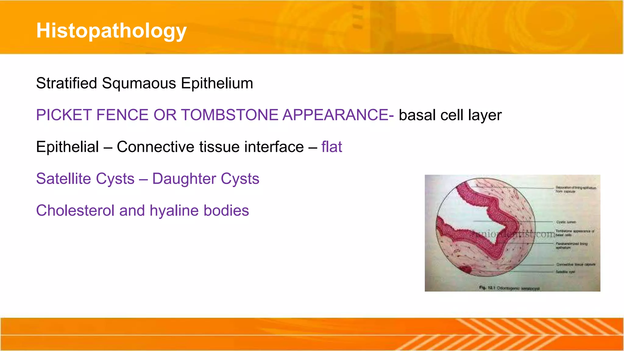 Histopathology
Stratified Squmaous Epithelium
PICKET FENCE OR TOMBSTONE APPEARANCE- basal cell layer
Epithelial – Connective tissue interface – flat
Satellite Cysts – Daughter Cysts
Cholesterol and hyaline bodies
 