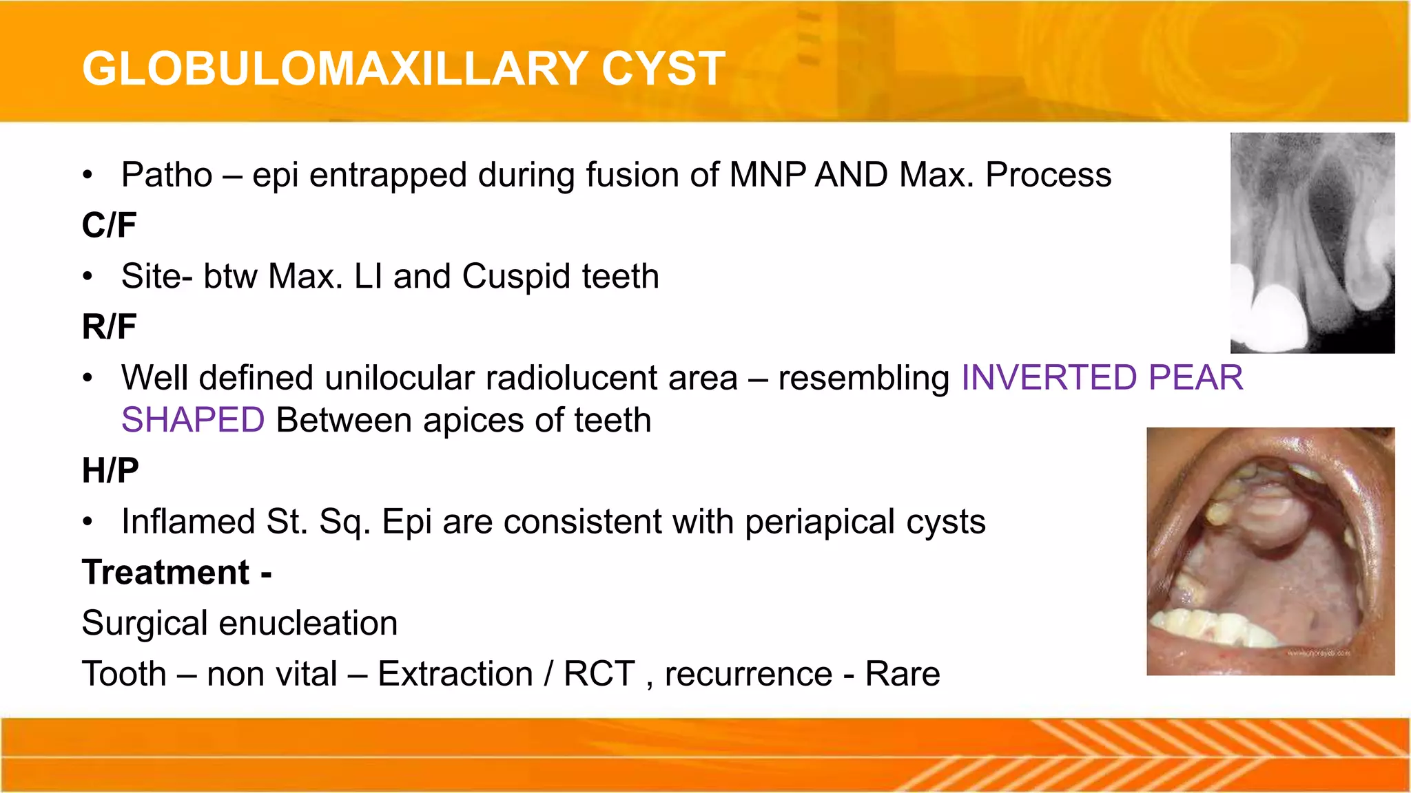 GLOBULOMAXILLARY CYST
• Patho – epi entrapped during fusion of MNP AND Max. Process
C/F
• Site- btw Max. LI and Cuspid teeth
R/F
• Well defined unilocular radiolucent area – resembling INVERTED PEAR
SHAPED Between apices of teeth
H/P
• Inflamed St. Sq. Epi are consistent with periapical cysts
Treatment -
Surgical enucleation
Tooth – non vital – Extraction / RCT , recurrence - Rare
 