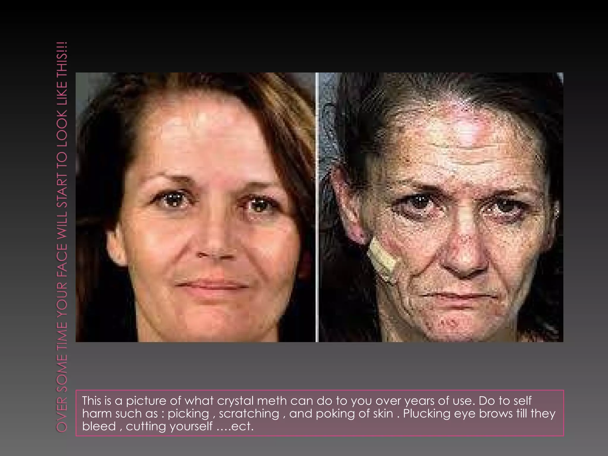 This is a picture of what crystal meth can do to you over years of use. Do to self harm such as : picking , scratching , and poking of skin . Plucking eye brows till they bleed , cutting yourself ….ect. 