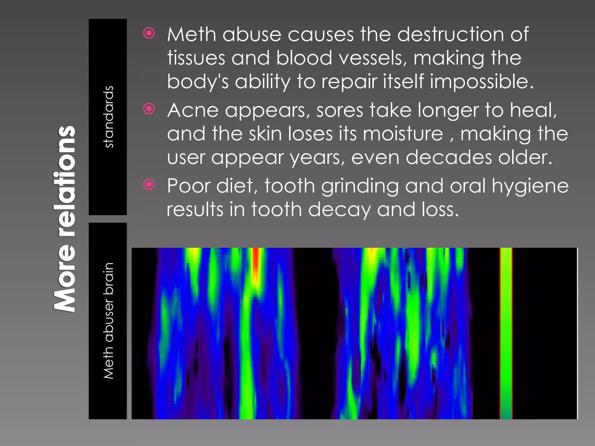 Meth abuse causes the destruction of tissues and blood vessels, making the body's ability to repair itself impossible. Acne appears, sores take longer to heal, and the skin loses its moisture , making the user appear years, even decades older. Poor diet, tooth grinding and oral hygiene results in tooth decay and loss. 