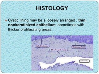 HISTOLOGY
 Cystic lining may be a loosely arranged , thin,
nonkeratinized epithelium, sometimes with
thicker proliferating areas.
 