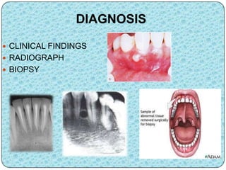 DIAGNOSIS
 CLINICAL FINDINGS
 RADIOGRAPH
 BIOPSY
 