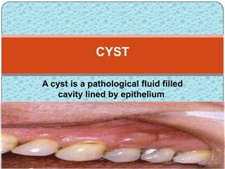 A cyst is a pathological fluid filled
cavity lined by epithelium.
CYST
 