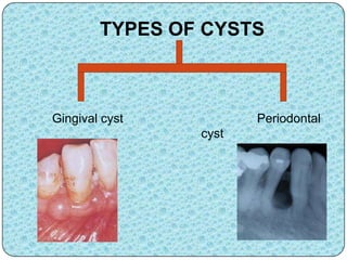 TYPES OF CYSTS
Gingival cyst Periodontal
cyst
 