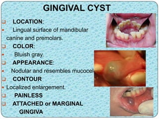 GINGIVAL CYST
 LOCATION:
 Lingual surface of mandibular
canine and premolars.
 COLOR:
 Bluish gray.
 APPEARANCE:
 Nodular and resembles mucocele
 CONTOUR
 Localized enlargement.
 PAINLESS
 ATTACHED or MARGINAL
GINGIVA
 