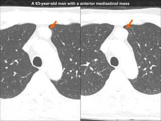 CT A 63-year-old man with a anterior mediastinal mass 