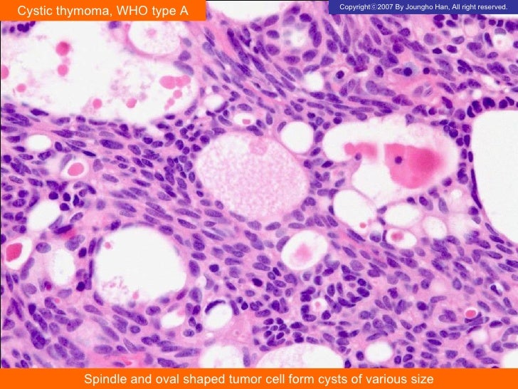 Cystic Thymoma
