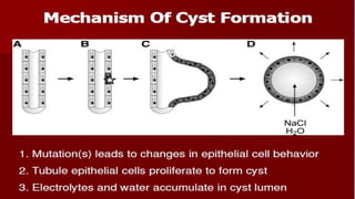Cystic diseases of kidney | PPT