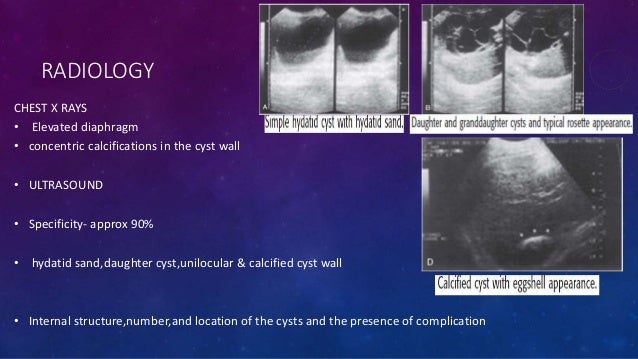 Cystic diseases of liver includes pyogenic . amoebic and ...
