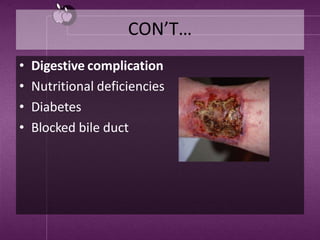CON’T…
• Digestive complication
• Nutritional deficiencies
• Diabetes
• Blocked bile duct
 