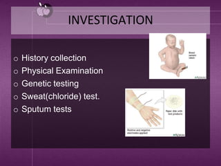 INVESTIGATION
o History collection
o Physical Examination
o Genetic testing
o Sweat(chloride) test.
o Sputum tests
 