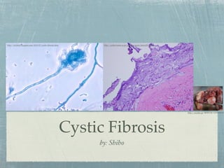 http://rd-ﬁeld.blogspot.com/2010/07/cystic-ﬁbrosis.html         http://pathol.umin.ac.jp/gakubu/exam/jissyu2010.htm




                                                                                                                      http://meddic.jp/




                                                          Cystic Fibrosis
                                                               by: Shiho
 