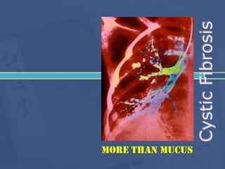 Cystic Fibrosis
More than mucus

 