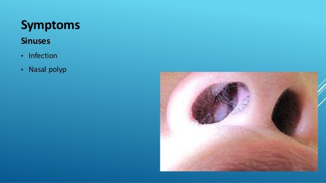 Cystic fibrosis Cystic fibrosis