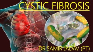 CYSTIC FIBROSIS
DR.SAMIR JADAV (PT)
 