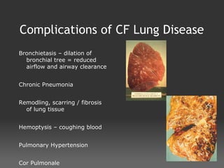 Cystic fibrosis[1] | ODP