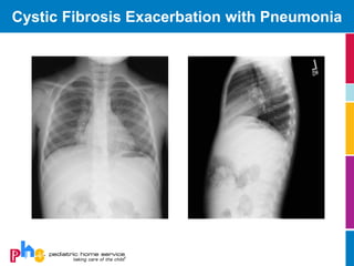 Cystic Fibrosis | PDF