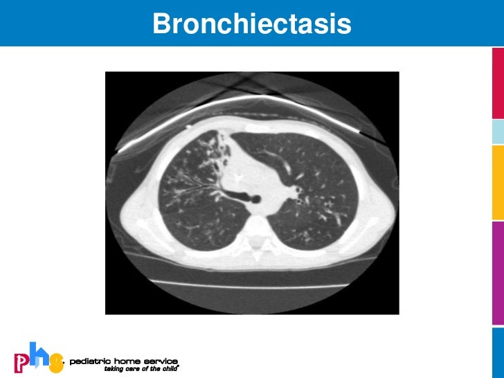 Zithromax Cystic Fibrosis