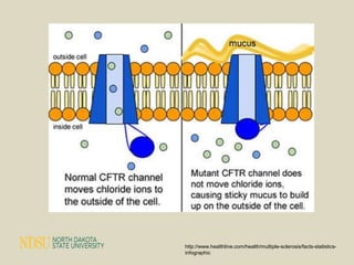 Cystic fibrosis case study | PPTX