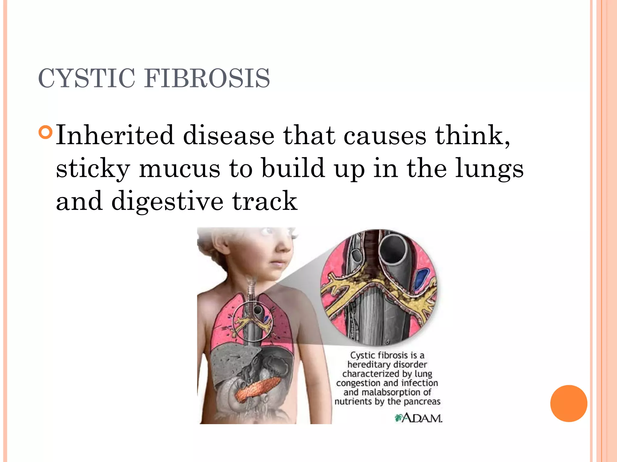 CYSTIC FIBROSIS
Inherited disease that causes think,
sticky mucus to build up in the lungs
and digestive track