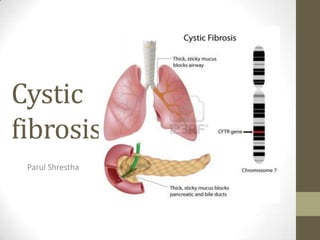 Cystic
fibrosis
Parul Shrestha
 