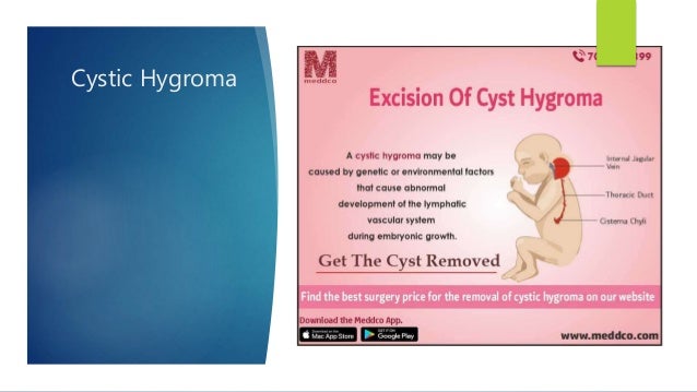 Cystic Hygroma
 