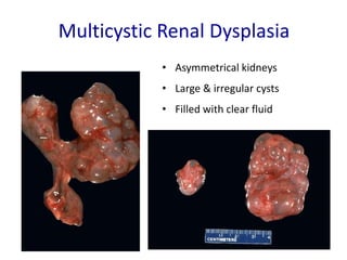 cystic kidney.pptx