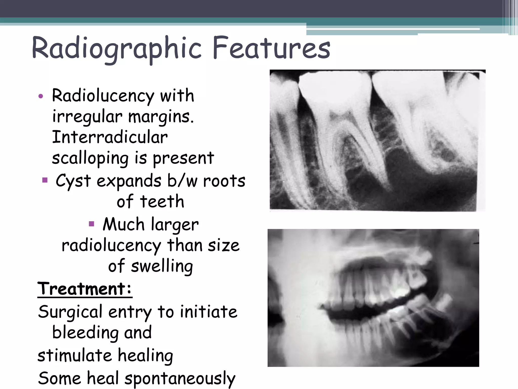 Cystic lesions in oral cavity | PPTX