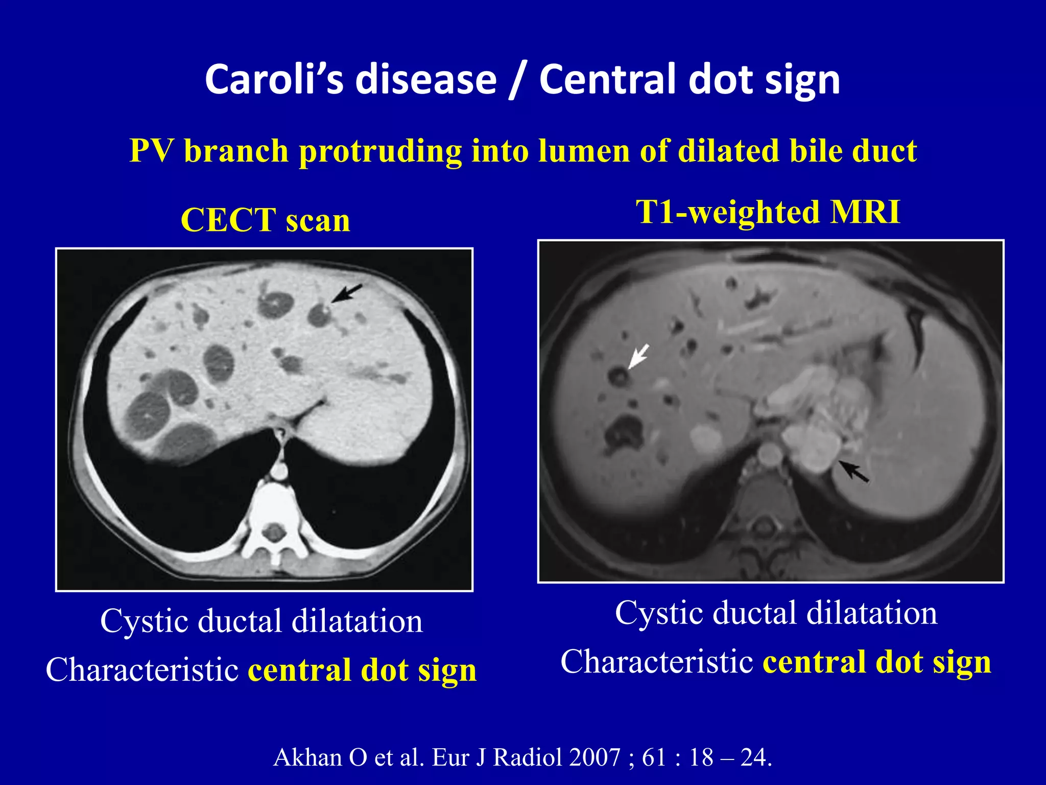 Akhan Sign Cystic liver lesions - An ultrasound perspective | PPTX