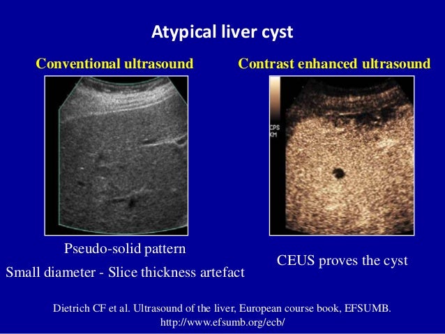 Cystic liver lesions - An ultrasound perspective