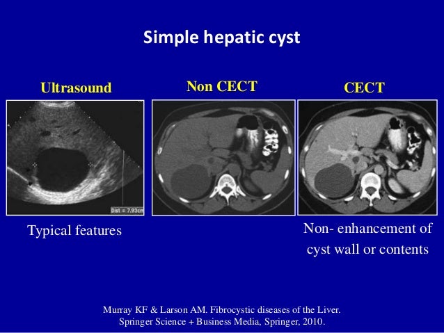 What does it mean if you have a hepatic cyst in your liver?