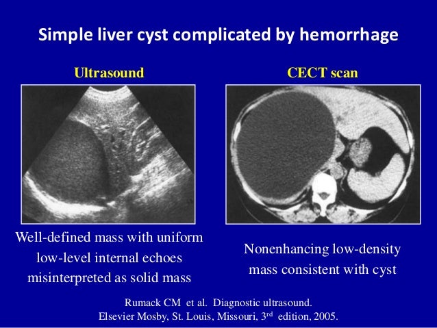 Contentscectultrasoundtypical Features 8 Simple Liver Cyst Contentscectultrasoundtypical Features 8 Simple Liver Cyst
