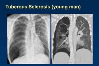 Tuberous Sclerosis (young man)
 