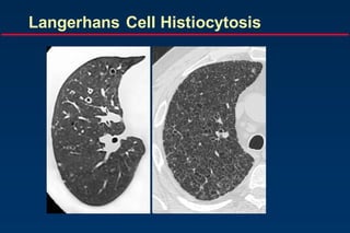 Langerhans Cell Histiocytosis
 