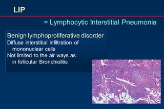 Benign lymphoproliferative disorder
Diffuse interstitial infiltration of
mononuclear cells
Not limited to the air ways as
in follicular Bronchiolitis
LIP
= Lymphocytic Interstitial Pneumonia
 
