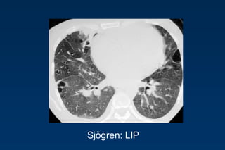 Sjögren: LIP
 