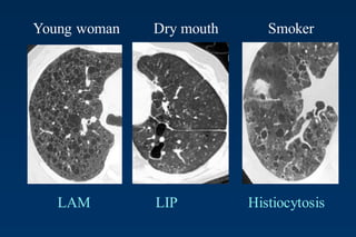 Young woman Dry mouth Smoker
LAM LIP Histiocytosis
 