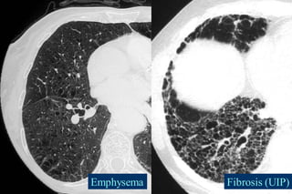 Emphysema Fibrosis (UIP)
 