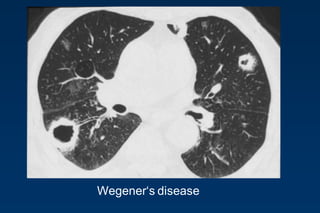 Wegener„s disease
 