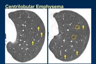 Centrilobular Emphysema
 