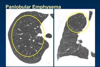 Panlobular Emphysema
 