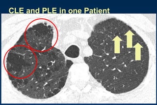 CLE and PLE in one Patient
 