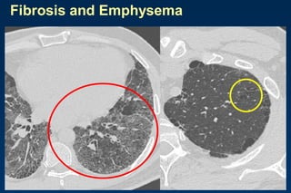 Fibrosis and Emphysema
 