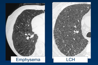 LCHEmphysema
 