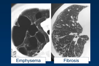 FibrosisEmphysema
 