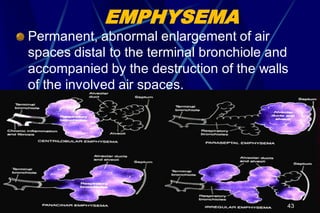EMPHYSEMA
Permanent, abnormal enlargement of air
spaces distal to the terminal bronchiole and
accompanied by the destruction of the walls
of the involved air spaces.
43
 