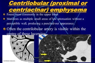 Centrilobular (proximal or
centriacinar) emphysema
Found most commonly in the upper lobes
Manifests as multiple small areas of low attenuation without a
perceptible wall, producing a punched-out appearance.
Often the centrilobular artery is visible within the
centre of these lucencies.
45
 